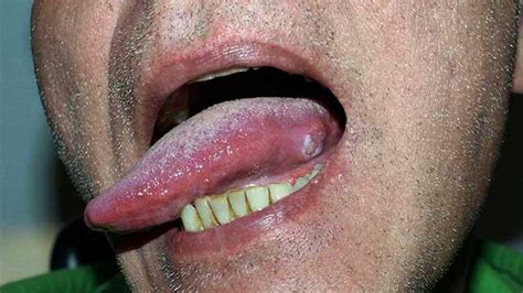 You may have one or more bumps on the surface of the tongue. . Pictures of tongue cancer bumps